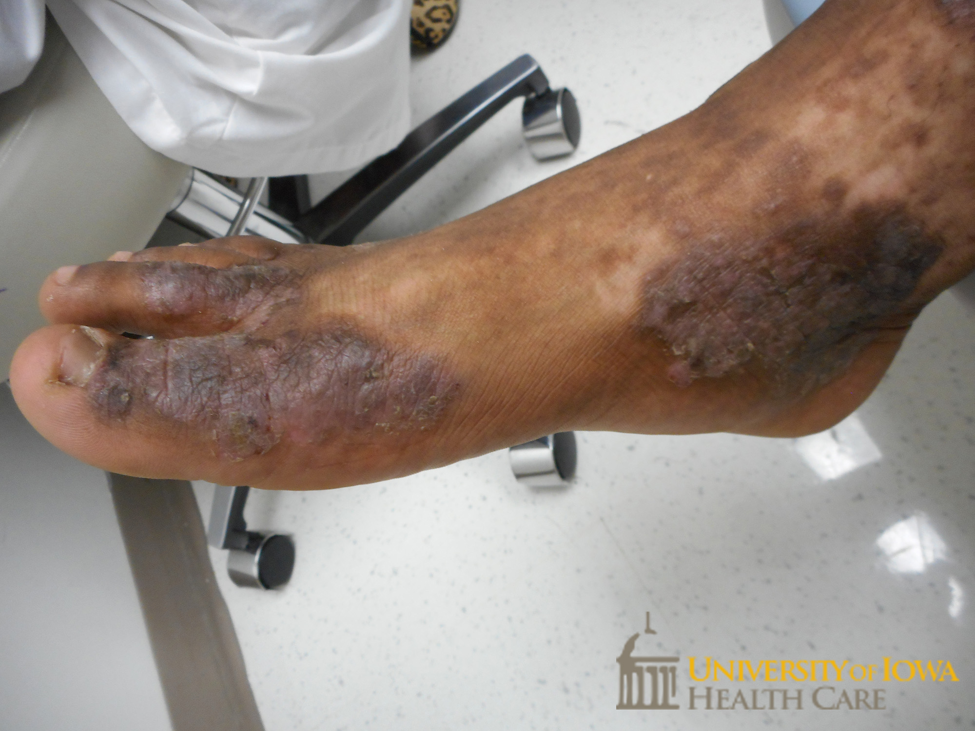 Hyperpigmented to erythematous lichenified scaly plaques on the dorsal toes and medial leg. (click images for higher resolution).